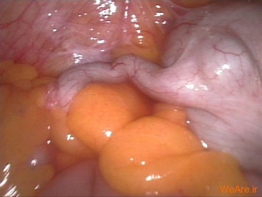 آپاندیس کرمی شکل (Vermiform Appendix)
